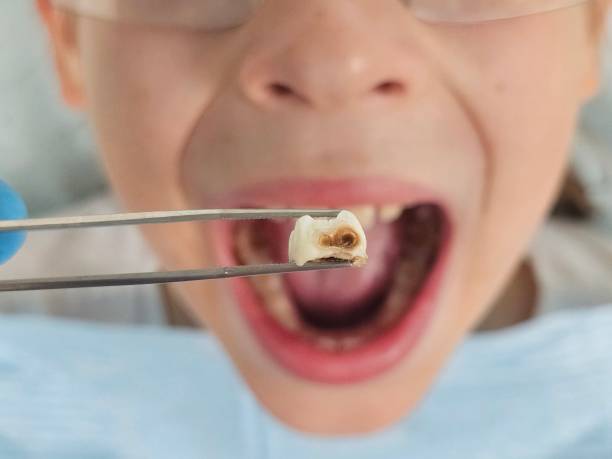 Best Emergency Wisdom Teeth Removal in Chicago Heights, IL